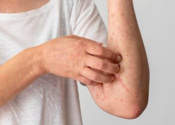 Alergia: saiba como se cuidar e os tratamentos oferecidos pelo SUS