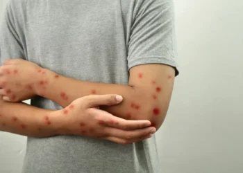 Nova variante da Mpox acende alerta para vigilância genômica em 2026