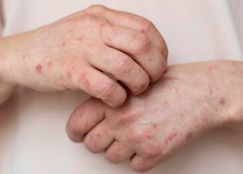 Especialistas da Rede HU Brasil alertam para prevenção, diagnóstico e tratamento da sífilis