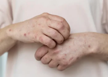 Ataque de abelhas: saiba como agir e identificar sinais de gravidade